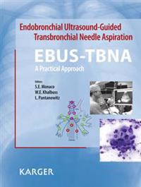 Endobronchial Ultrasound-Guided Transbronchial Needle Aspiration (EBUS-TBNA): A Practical Approach