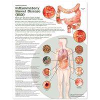 Understanding Inflammatory Bowel Disease (Ibd) Anatomical Chart