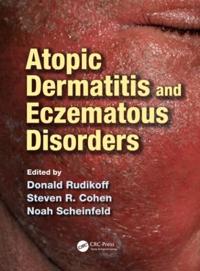 Atopic Dermatitis and Eczematous Disorders