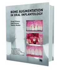 Bone Augmentation in Oral Implantology