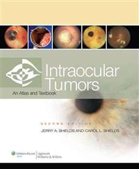 Intraocular Tumors