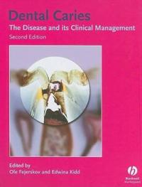 Dental Caries: The Disease and Its Clinical Management
