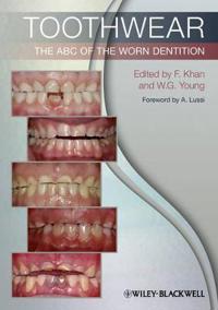 Toothwear: The ABC of the Worn Dentition